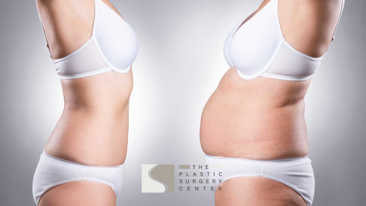 uneven weight gain after liposuction