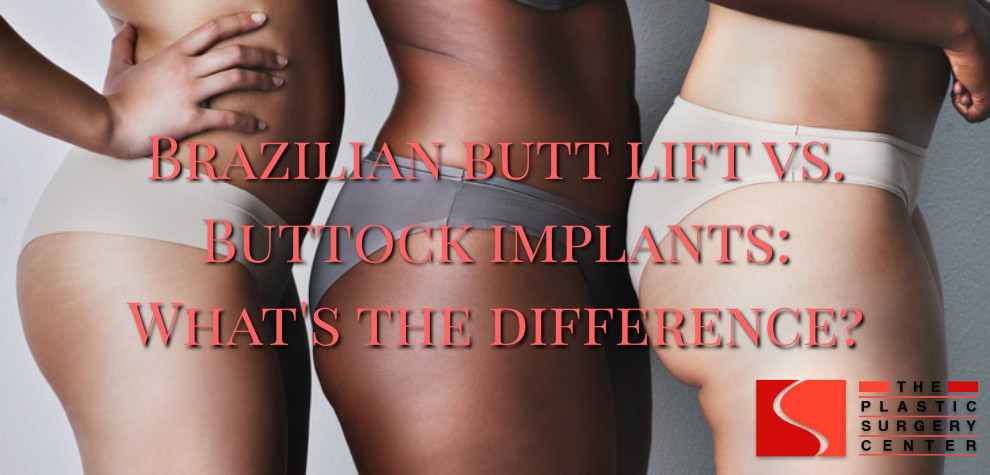 Buttock Lift vs. Butt Implants vs. BBL: What's the Difference? - Dr.  Vasilakis
